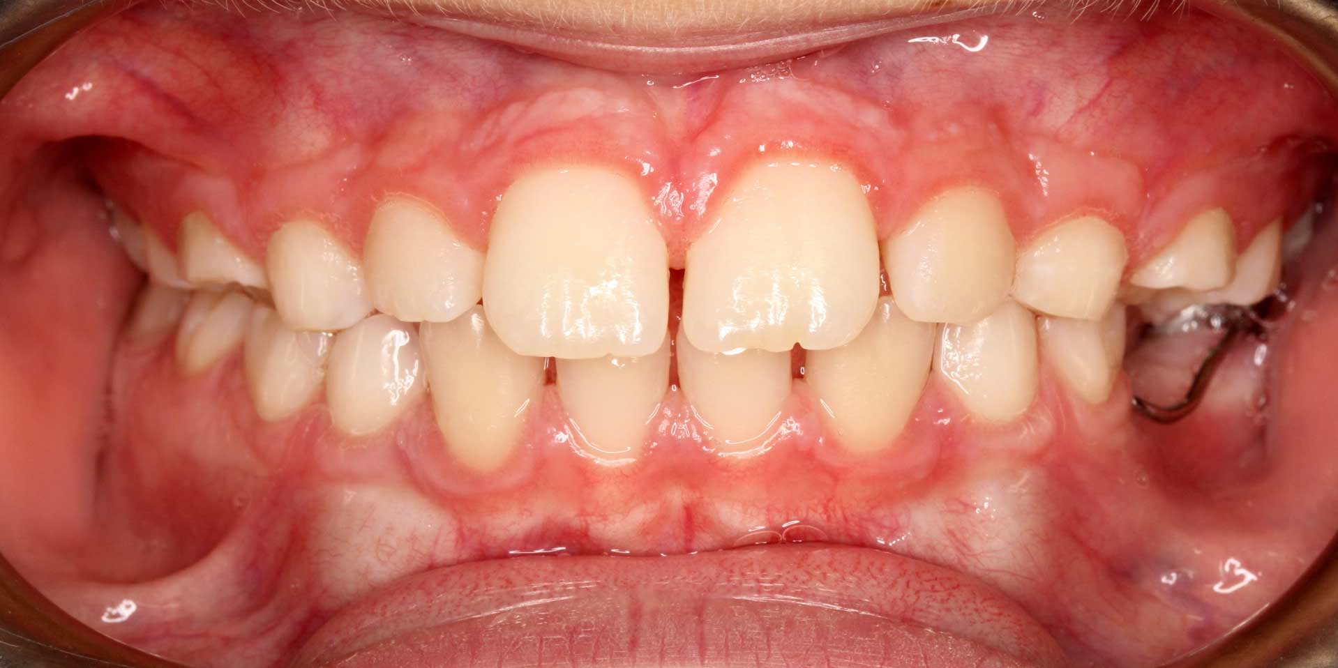 How to Take Intra-oral Pictures