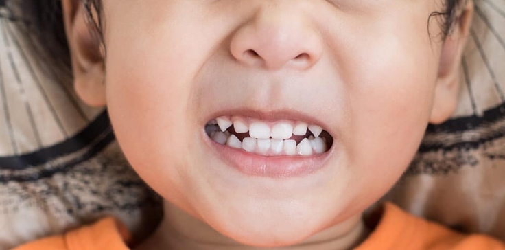 Navigating Through Nighttime Grinding: Understanding and Managing Toddler Bruxism